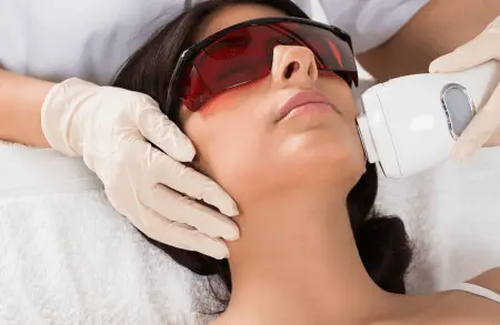 Laser hair removal on the face