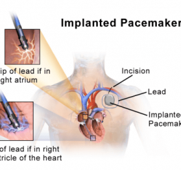 Difference between a Pacemaker and an ICD