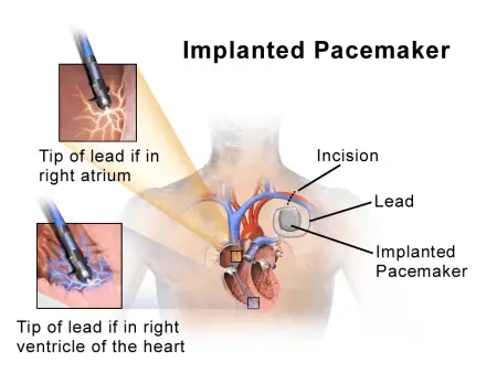 Implanted pacemaker