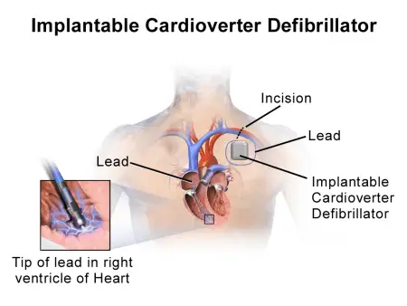 implantable cardioverter defibrillator (ICD)