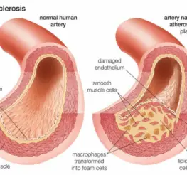 Difference between Atherosclerosis and Arteriosclerosis