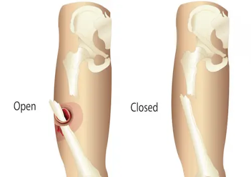 open and a closed fractures