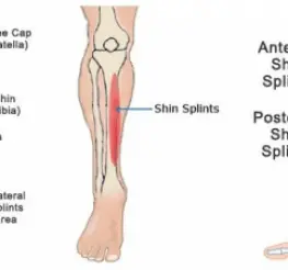 Difference between Shin Splints and Stress Fractures