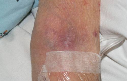 Difference Between Phlebitis and Infiltration