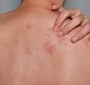 Difference Between Chickenpox And Shingles