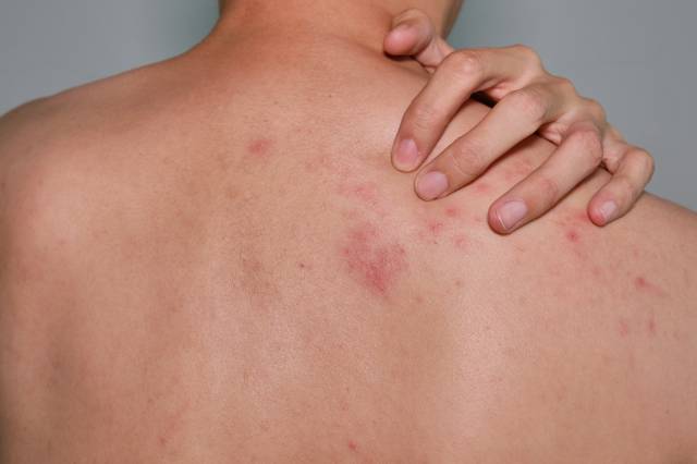 Difference Between Chickenpox And Shingles